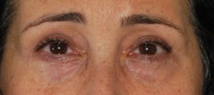 Blepharoplasty Before and After Pictures Buffalo, NY