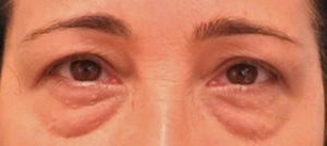 Blepharoplasty Before and After Pictures Buffalo, NY