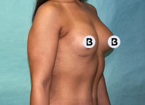 Breast Augmentation Before and After Pictures Buffalo, NY