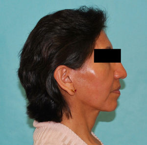 Facelift Before and After Pictures Buffalo, NY