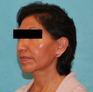 Facelift Before and After Pictures Buffalo, NY