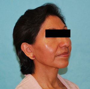 Facelift Before and After Pictures Buffalo, NY
