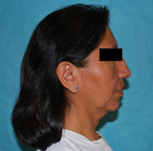 Facelift Before and After Pictures Buffalo, NY