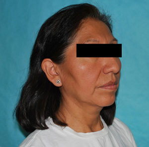 Facelift Before and After Pictures Buffalo, NY