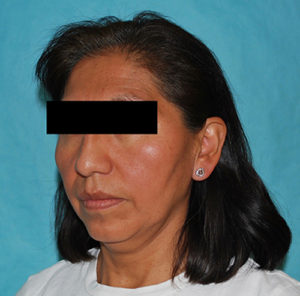 Facelift Before and After Pictures Buffalo, NY