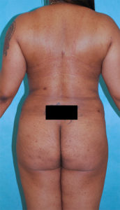 Liposuction Before and After Pictures Buffalo, NY