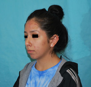 Rhinoplasty (Nose Surgery) Before and After Pictures Buffalo, NY