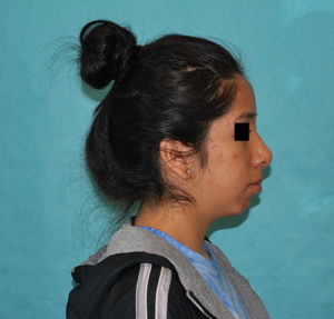 Rhinoplasty (Nose Surgery) Before and After Pictures Buffalo, NY