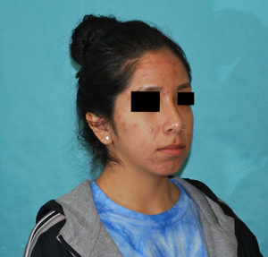 Rhinoplasty (Nose Surgery) Before and After Pictures Buffalo, NY