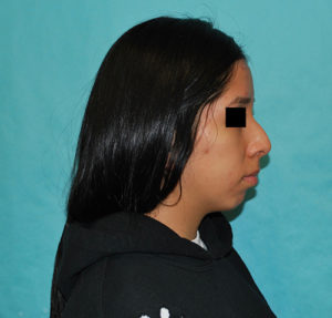 Rhinoplasty (Nose Surgery) Before and After Pictures Buffalo, NY