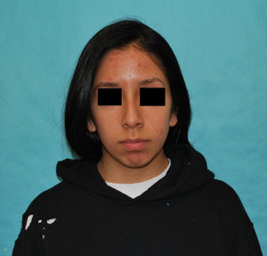 Rhinoplasty (Nose Surgery) Before and After Pictures Buffalo, NY