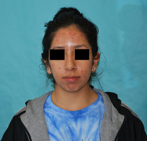 Rhinoplasty (Nose Surgery) Before and After Pictures Buffalo, NY
