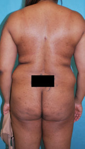 Liposuction Before and After Pictures Buffalo, NY