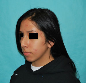 Rhinoplasty (Nose Surgery) Before and After Pictures Buffalo, NY
