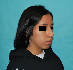 Rhinoplasty (Nose Surgery) Before and After Pictures Buffalo, NY