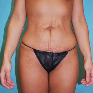 Abdominoplasty (Tummy Tuck) Before and After Pictures Buffalo, NY