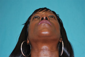 Rhinoplasty (Nose Surgery) Before and After Pictures Buffalo, NY