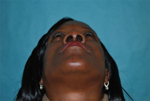 Rhinoplasty (Nose Surgery) Before and After Pictures Buffalo, NY