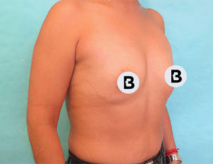 Breast Augmentation Before and After Pictures Buffalo, NY