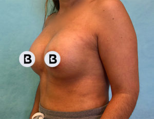Breast Augmentation Before and After Pictures Buffalo, NY