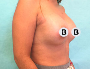 Breast Augmentation Before and After Pictures Buffalo, NY
