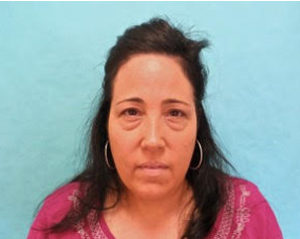 Blepharoplasty Before and After Pictures Buffalo, NY