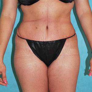 Abdominoplasty (Tummy Tuck) Before and After Pictures Buffalo, NY
