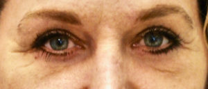 Blepharoplasty Before and After Pictures Buffalo, NY
