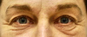 Blepharoplasty Before and After Pictures Buffalo, NY