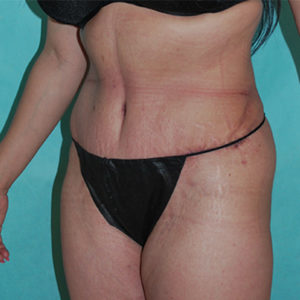 Abdominoplasty (Tummy Tuck) Before and After Pictures Buffalo, NY