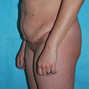 Abdominoplasty (Tummy Tuck) Before and After Pictures Buffalo, NY