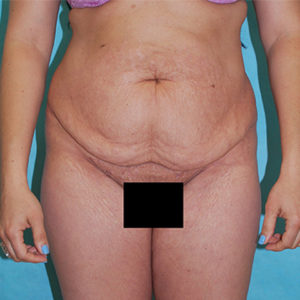 Abdominoplasty (Tummy Tuck) Before and After Pictures Buffalo, NY