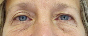 Blepharoplasty (Eyelid Surgery) Before and After Pictures Buffalo, NY