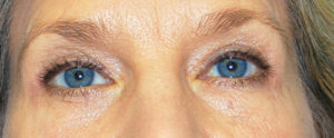 Blepharoplasty (Eyelid Surgery) Before and After Pictures Buffalo, NY