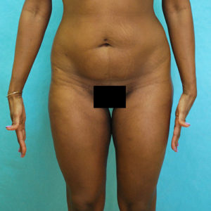 Abdominoplasty (Tummy Tuck) Before and After Pictures Buffalo, NY