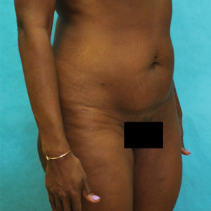 Abdominoplasty (Tummy Tuck) Before and After Pictures Buffalo, NY