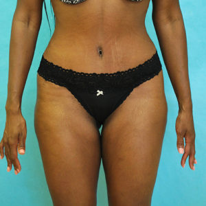 Abdominoplasty (Tummy Tuck) Before and After Pictures Buffalo, NY