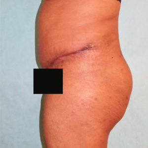 Abdominoplasty (Tummy Tuck) Before and After Pictures Buffalo, NY