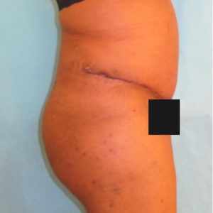 Abdominoplasty (Tummy Tuck) Before and After Pictures Buffalo, NY