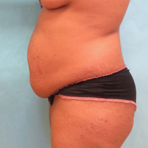 Abdominoplasty (Tummy Tuck) Before and After Pictures Buffalo, NY