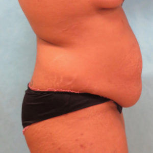 Abdominoplasty (Tummy Tuck) Before and After Pictures Buffalo, NY