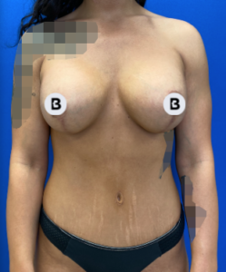 Abdominoplasty (Tummy Tuck) Before and After Pictures Buffalo, NY