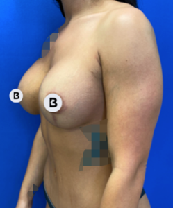 Abdominoplasty (Tummy Tuck) Before and After Pictures Buffalo, NY