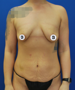 Abdominoplasty (Tummy Tuck) Before and After Pictures Buffalo, NY