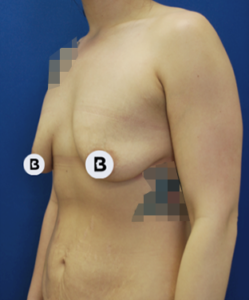 Abdominoplasty (Tummy Tuck) Before and After Pictures Buffalo, NY