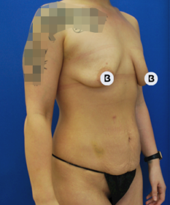 Abdominoplasty (Tummy Tuck) Before and After Pictures Buffalo, NY