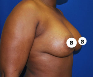Breast Augmentation Before and After Pictures Buffalo, NY