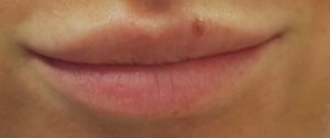 Fillers Before and After Pictures Buffalo, NY