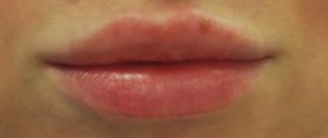 Fillers Before and After Pictures Buffalo, NY