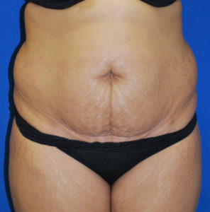Abdominoplasty (Tummy Tuck) Before and After Pictures Buffalo, NY